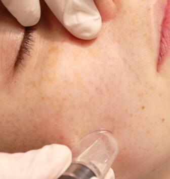 Microdermabrasie
